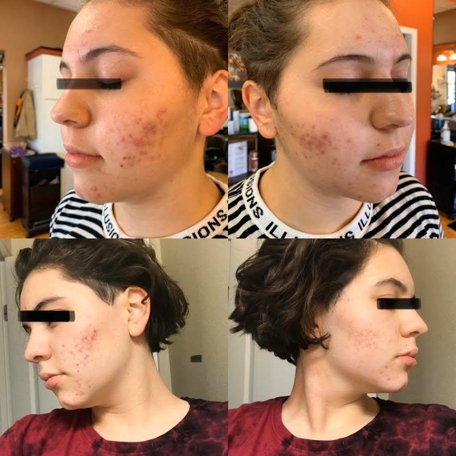 Client acne treatment before and after results