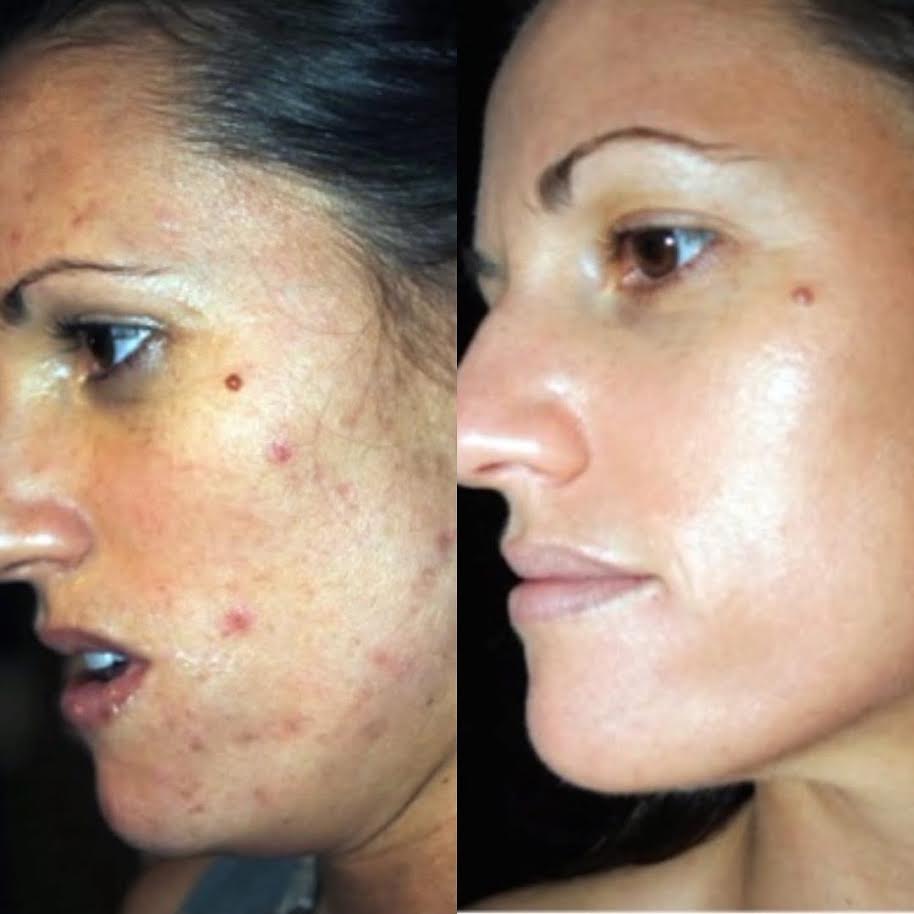 Client acne treatment before and after results