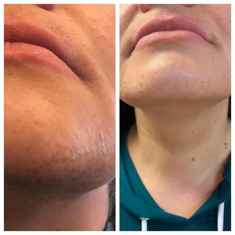 Client laser hair removal before and after result on chin