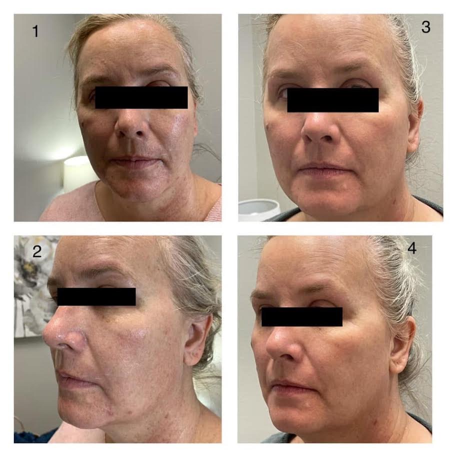 TriBella treatment client result showing multiple facial angles